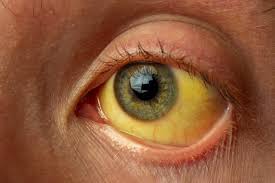 Jaundice can be cured in just 5 days