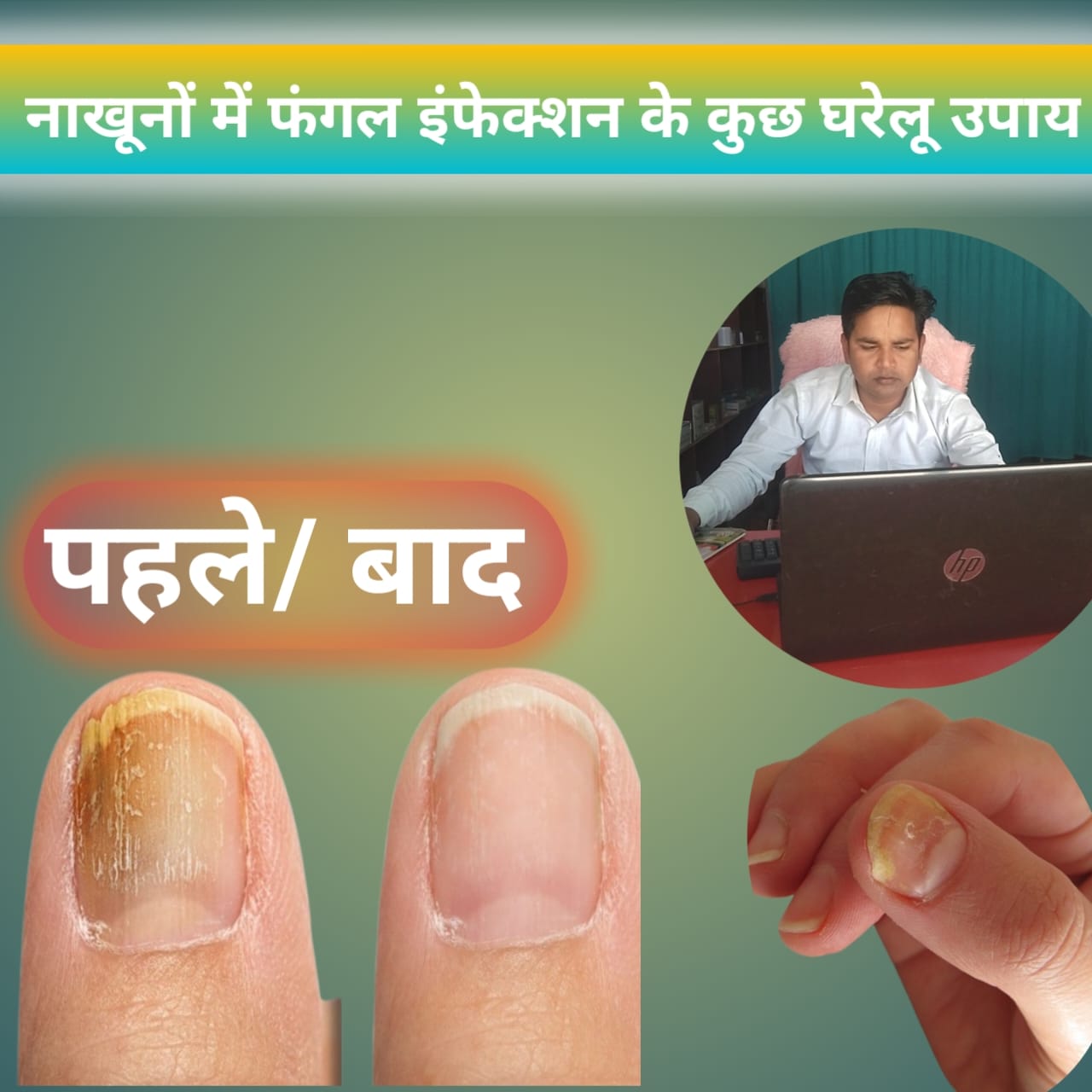 नेल फंगल संक्रमण के लिए कुछ घरेलू उपचार