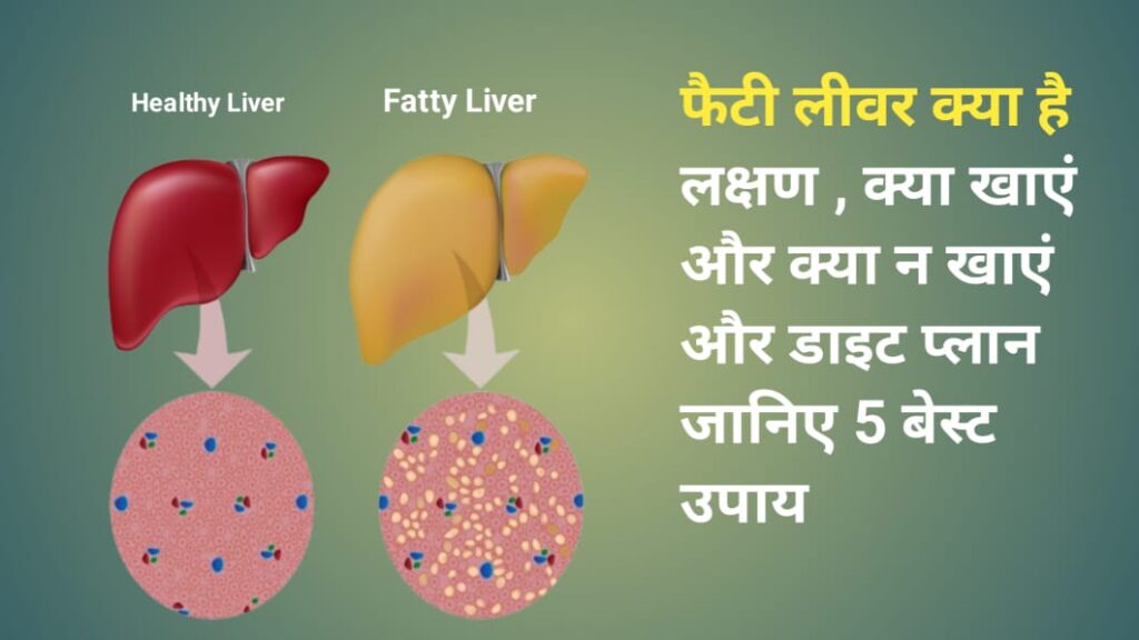 Fatty Liver : क्या है लक्षण व कारण ,उपाय जानिए 5 बेस्ट उपाय