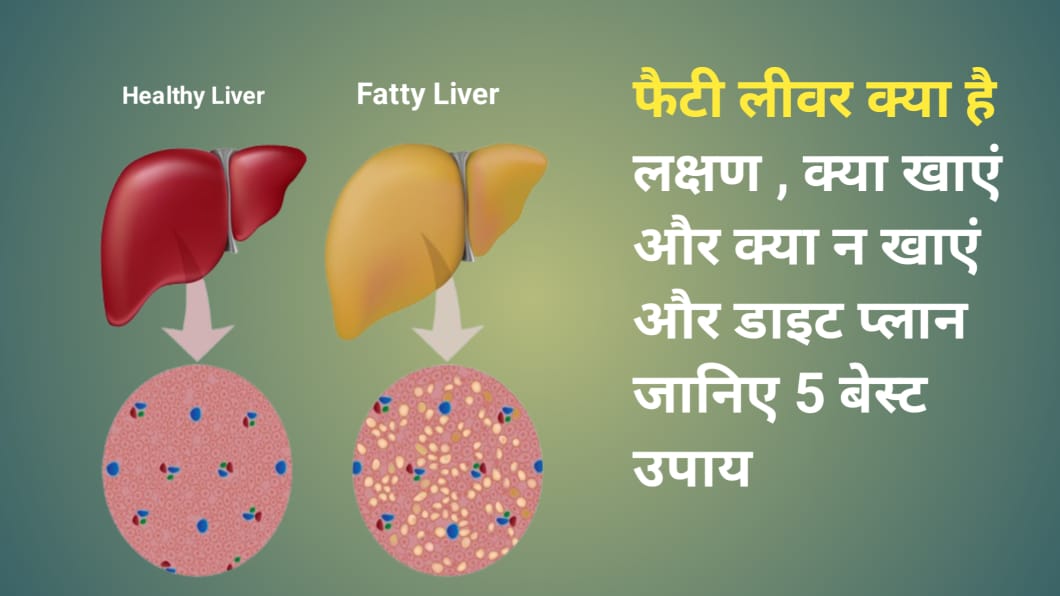 Fatty Liver : क्या है लक्षण व कारण ,उपाय जानिए 5 बेस्ट उपाय