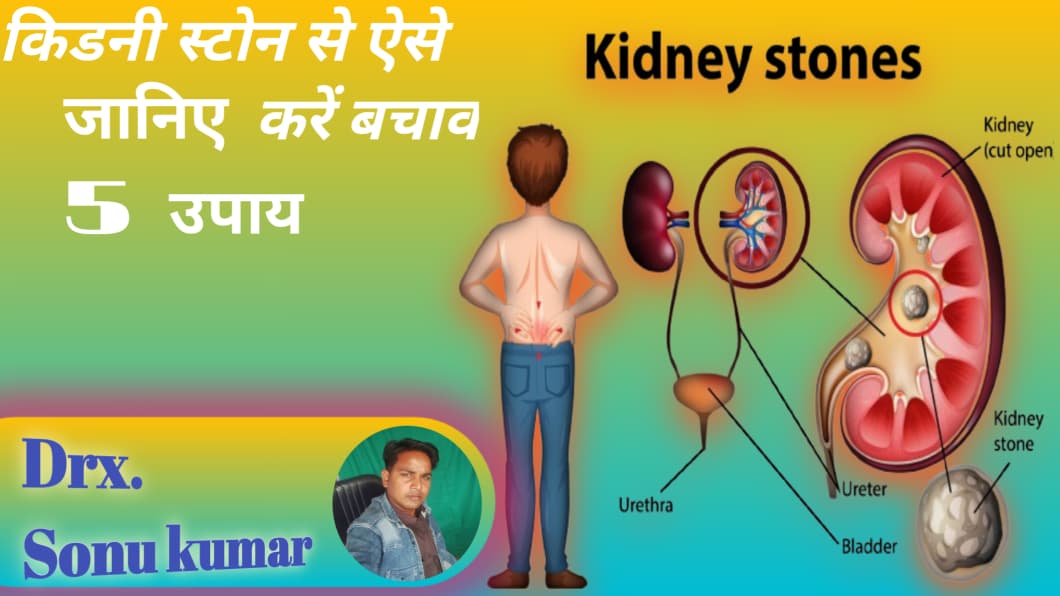 किडनी स्टोन