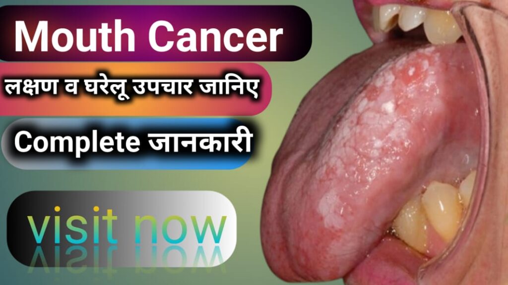 Mouth cancer