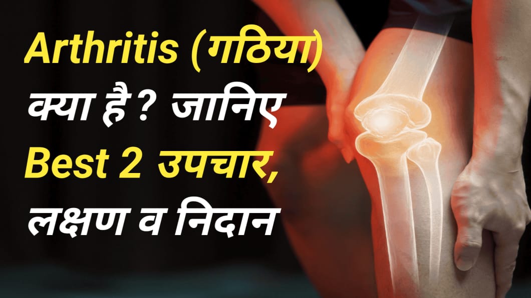Arthritis